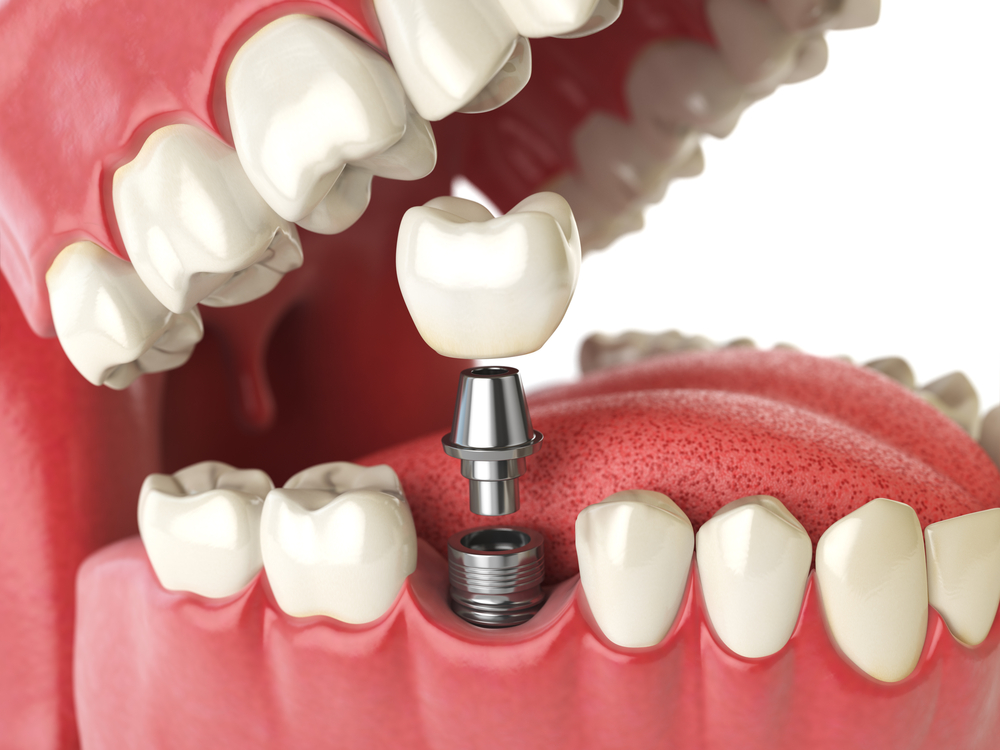 Dental Implants Evanston