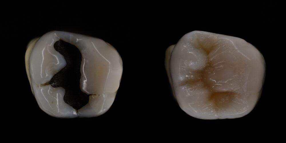 dental fillings Evanston
